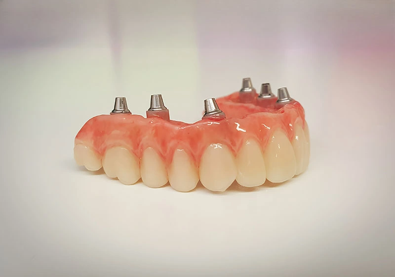 All on four implant