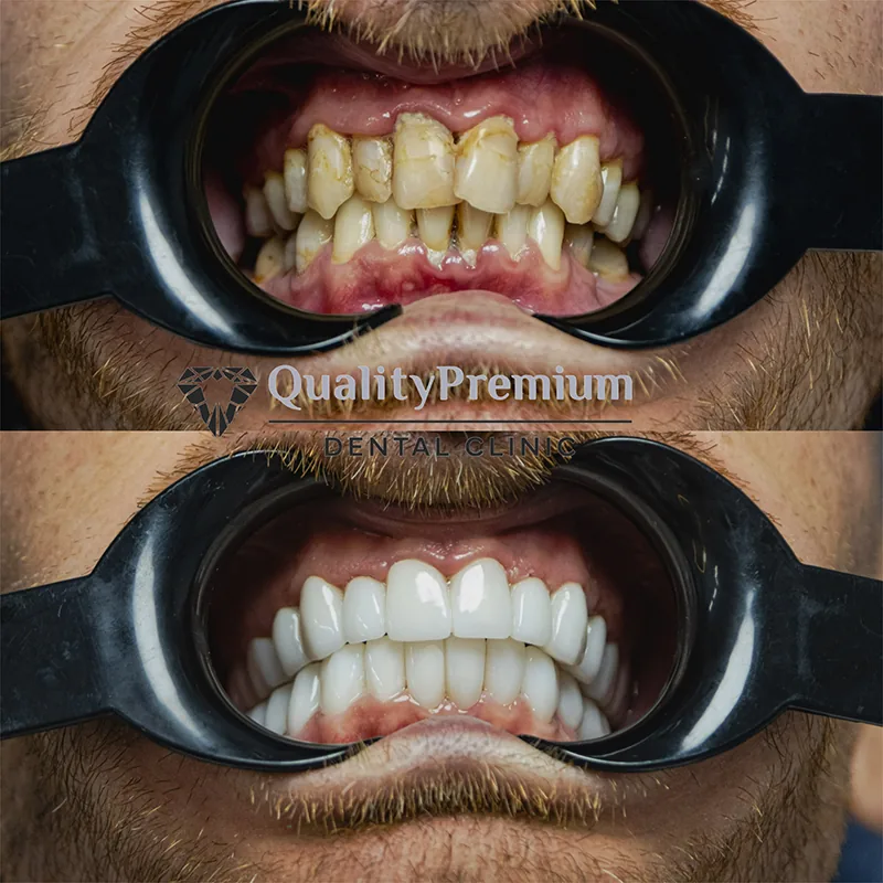 Before & After - Case 1