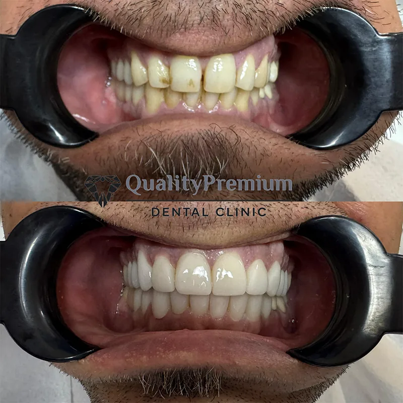 Before & After - Case 2