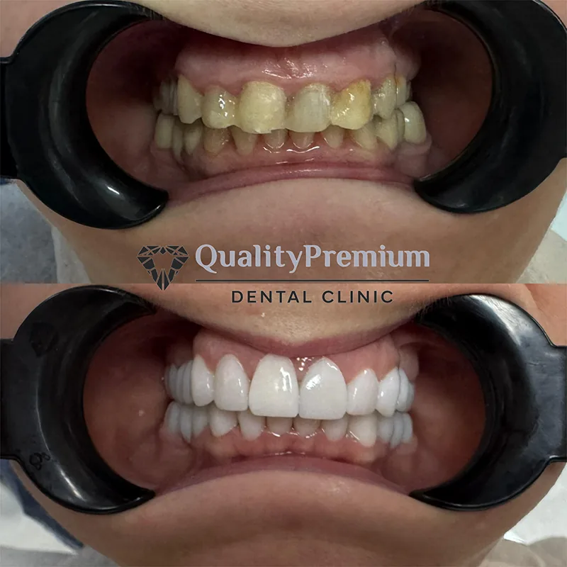 Before & After - Case 4