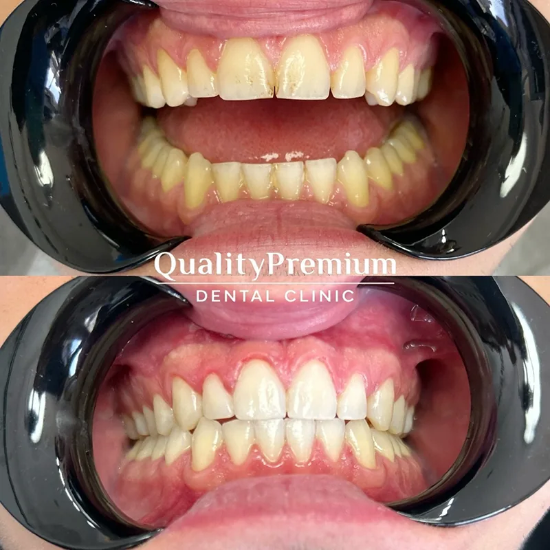 Before & After - Case 6