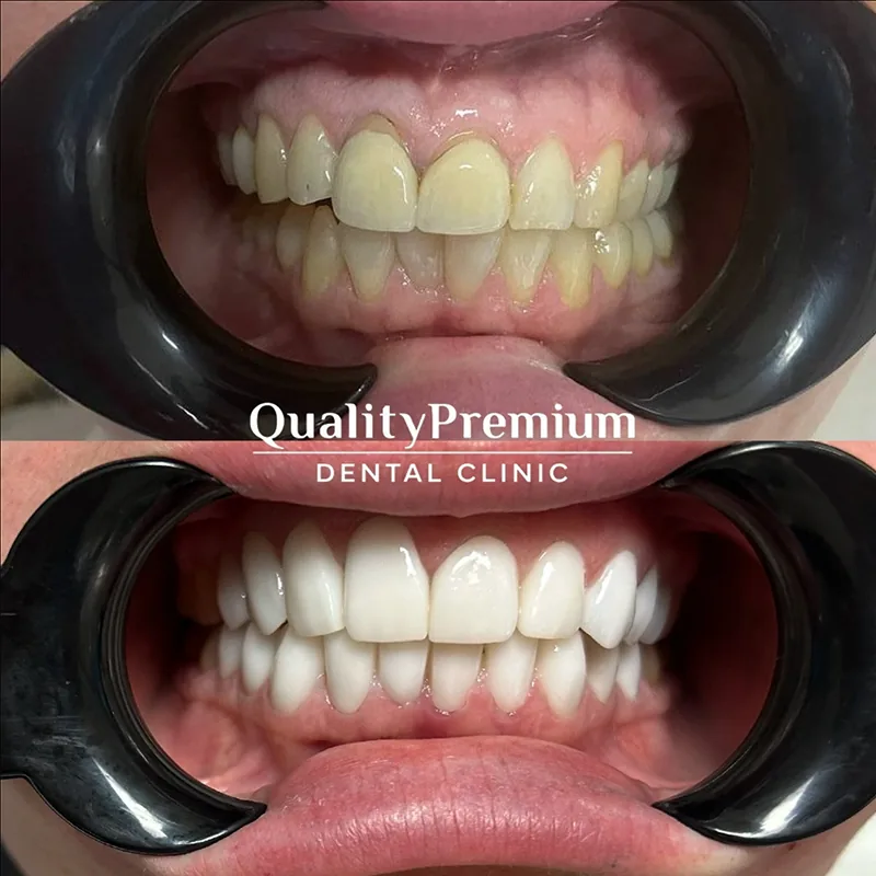 Before & After - Case 8