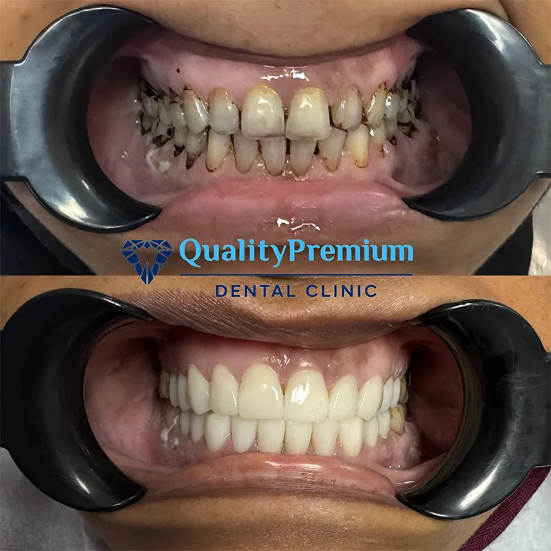 Before & After - Case 10