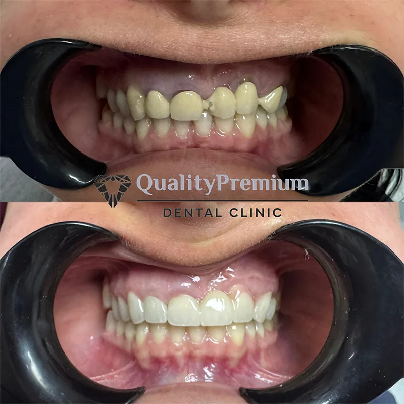 Before & After - Case 11