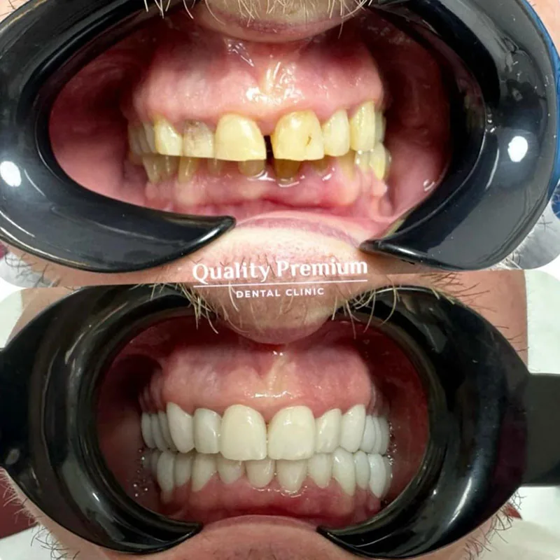 Before & After - Case 12