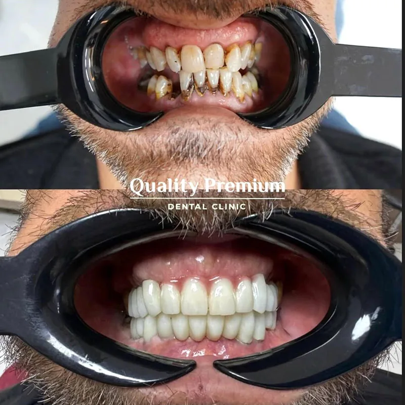 Before & After - Case 13