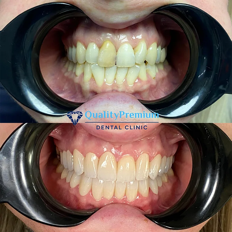 Before & After - Case 14