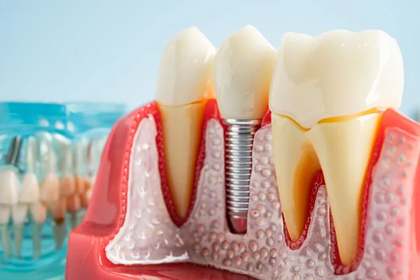 Dental Implants